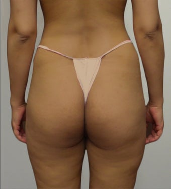 25-34 year old woman treated with Butt Lift before 2062912