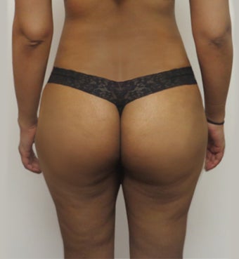 25-34 year old woman treated with Butt Lift after 2062912