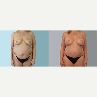53 yr old Female - Mommy Makeover before 3099744