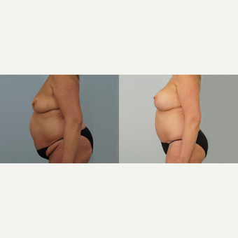 53 yr old Female - Mommy Makeover after 3099744