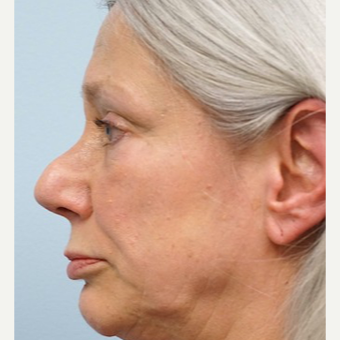 55-64 year old woman treated with Revision Rhinoplasty before 3686807
