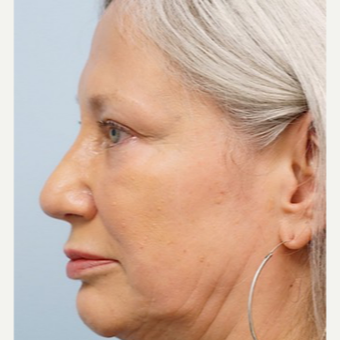 55-64 year old woman treated with Revision Rhinoplasty after 3686807