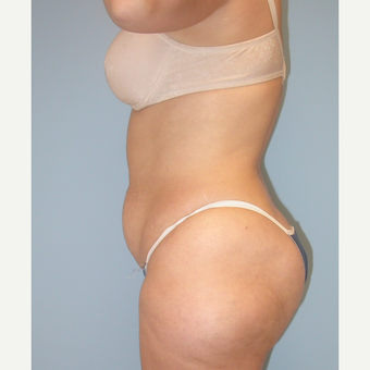 41 year old woman treated with Tummy Tuck before 3142117