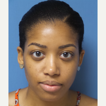25-34 year old woman treated with African American Rhinoplasty after 3098221