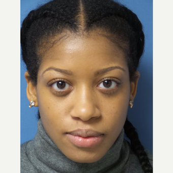 25-34 year old woman treated with African American Rhinoplasty before 3098221
