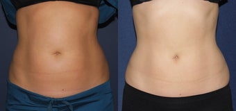 Before and After CoolSculpting before 1033831