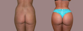 Brazilian Butt Lift to sculpt the waist, enlarge the butt before 1025965