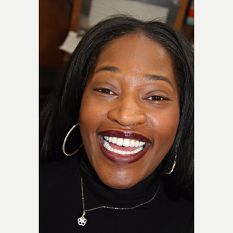 25-34 year old woman treated with Smile Makeover after 3213266
