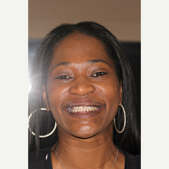 25-34 year old woman treated with Smile Makeover before 3213266