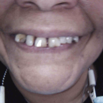 55-64 year old woman treated with Dental Crown before 2916029