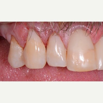 25-34 year old man treated with Tooth Repair after 2542885