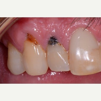 25-34 year old man treated with Tooth Repair before 2542885