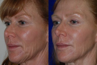 Liquid Facelift before 1376653