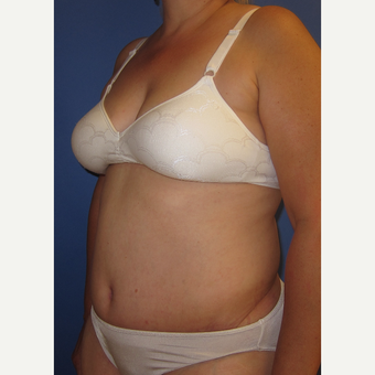 55-64 year old woman treated with Tummy Tuck after 3165554