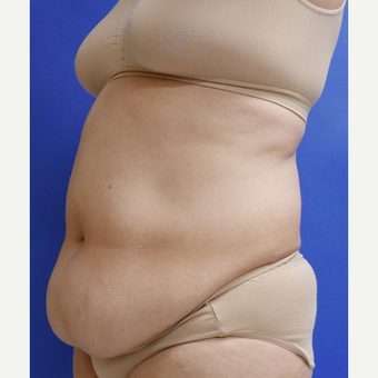55-64 year old woman treated with Tummy Tuck before 3165554