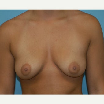 Patient requested natural results augmentation with Sientra implants before 1714109