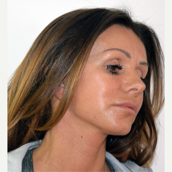 45-54 year old woman treated with Facelift after 3498643