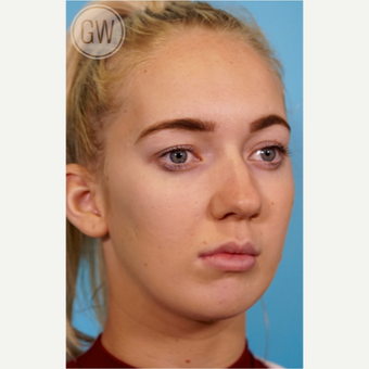 18-24 year old woman treated with Chin Surgery -Sliding Genioplasty before 3473441