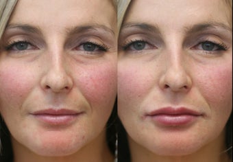 Lip augmentation with Juvederm before 824608