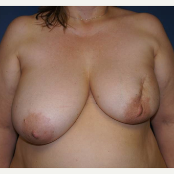 52 year old woman treated with DIEP flap Breast Reconstruction before 3383452
