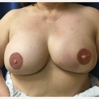 52 year old woman treated with DIEP flap Breast Reconstruction after 3383452