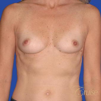 47 year old treated with silicone breast implants before 3522727