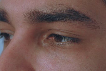 Dark Circles Under Eyes Before and After Restylane after 1105892