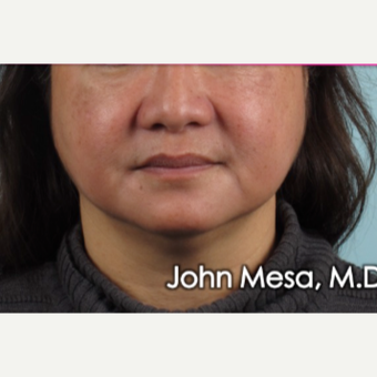 55-64 year old woman treated with Buccal Fat Removal before 3777301