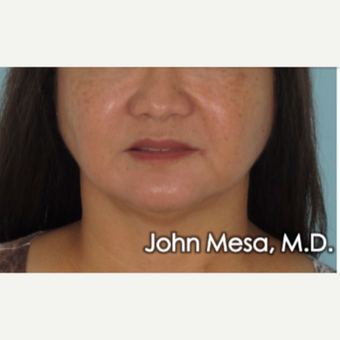 55-64 year old woman treated with Buccal Fat Removal after 3777301