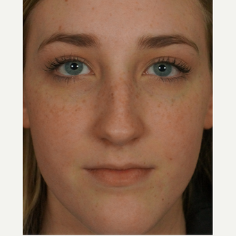18-24 year old woman treated with rhinoplasty before 3245047