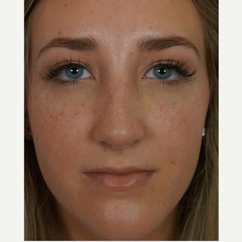 18-24 year old woman treated with rhinoplasty after 3245047
