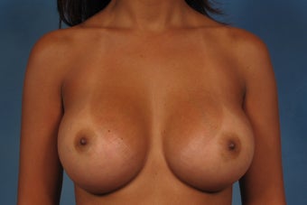 410 Cohesive Gel Breast Implants after 1112423