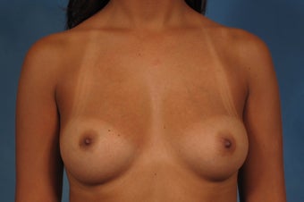 410 Cohesive Gel Breast Implants before 1112423