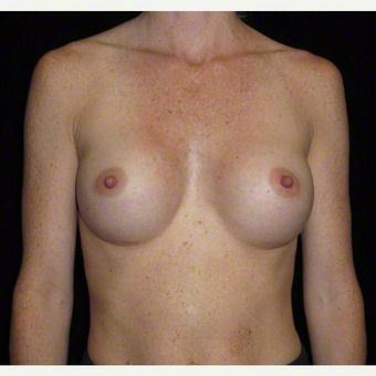 29 year old woman treated with Breast Augmentation after 3103603