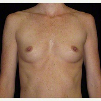 29 year old woman treated with Breast Augmentation before 3103603