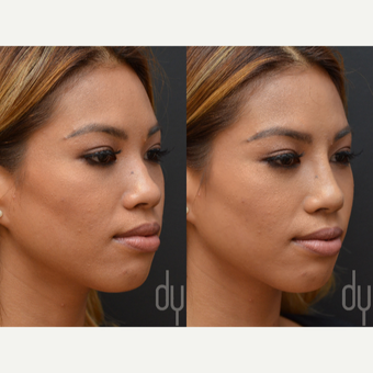 Non Surgical Nose Job before 3622617