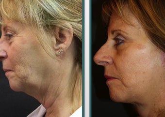 Facelift and eyelid surgery before 1065258
