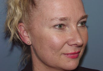 Patient requesting correction for sub-optimal results after esthetic nasal surgery 892528