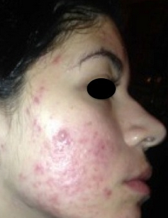 17 or under year old woman treated with Accutane before 2142774