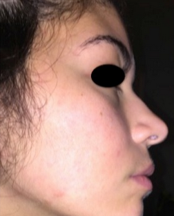17 or under year old woman treated with Accutane after 2142774