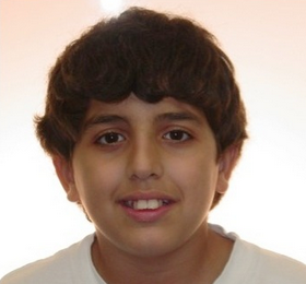 Severe Crowding and Overjet with Narrow Smile Treated Non-extraction with Braces 1932403