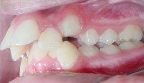 Severe Crowding and Overjet with Narrow Smile Treated Non-extraction with Braces before 1932403