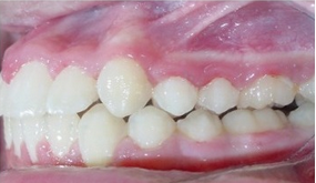 Severe Crowding and Overjet with Narrow Smile Treated Non-extraction with Braces after 1932403