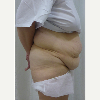45-54 year old woman treated with Body Lift before 3419920