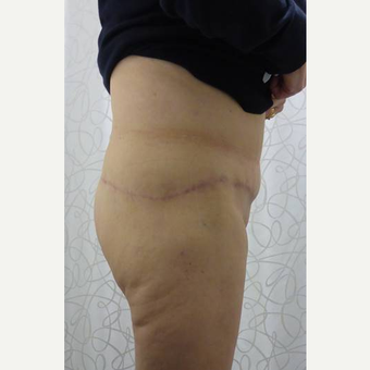 45-54 year old woman treated with Body Lift after 3419920