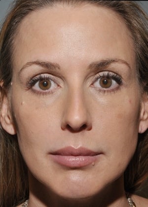 Young woman had decreased volume after 633394