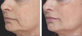 Voluma Filler to Lift and Rejuvenate the Face. 1482550