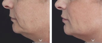 Voluma Filler to Lift and Rejuvenate the Face. after 1482550