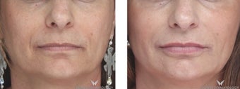 Voluma Filler to Lift and Rejuvenate the Face. before 1482550