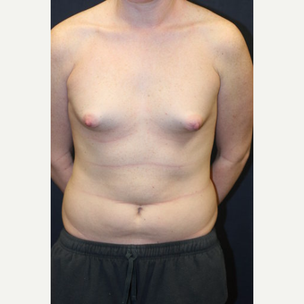21 year old woman treated with Mentor Breast Implants before 3695675